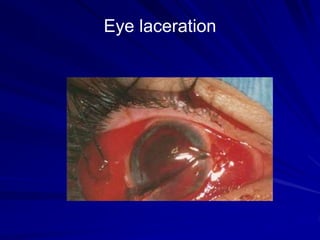 Eye laceration
 