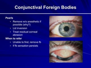 Conjunctival Foreign Bodies
Pearls
• Remove w/o anesthetic if
possible (why?)
• Lid inversion
• Treat residual corneal
abrasion
When to refer
• Unable to find, remove fb
• If fb sensation persists
 
