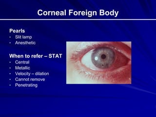 Corneal Foreign Body
Pearls
• Slit lamp
• Anesthetic
When to refer – STAT
• Central
• Metallic
• Velocity – dilation
• Cannot remove
• Penetrating
 