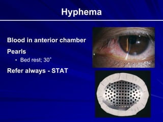 Hyphema
Blood in anterior chamber
Pearls
• Bed rest; 30°
Refer always - STAT
 