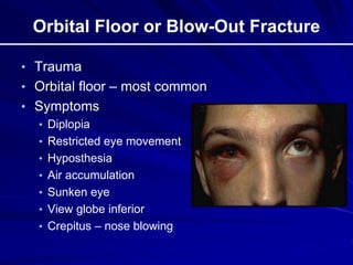 Orbital Floor or Blow-Out Fracture
• Trauma
• Orbital floor – most common
• Symptoms
• Diplopia
• Restricted eye movement
• Hyposthesia
• Air accumulation
• Sunken eye
• View globe inferior
• Crepitus – nose blowing
 