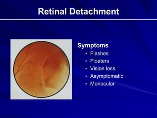 Retinal Detachment
Symptoms
• Flashes
• Floaters
• Vision loss
• Asymptomatic
• Monocular
 