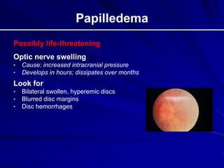 Papilledema
Possibly life-threatening
Optic nerve swelling
• Cause: increased intracranial pressure
• Develops in hours; dissipates over months
Look for
• Bilateral swollen, hyperemic discs
• Blurred disc margins
• Disc hemorrhages
 