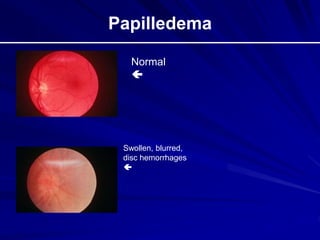 Papilledema
Normal

Swollen, blurred,
disc hemorrhages

 