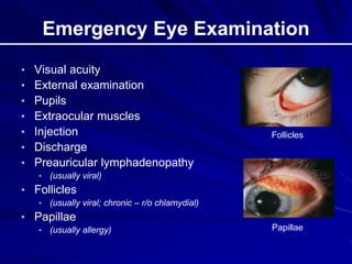 Emergency Eye Examination
• Visual acuity
• External examination
• Pupils
• Extraocular muscles
• Injection
• Discharge
• Preauricular lymphadenopathy
• (usually viral)
• Follicles
• (usually viral; chronic – r/o chlamydial)
• Papillae
• (usually allergy)
Follicles
Papillae
 