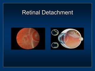 Ocular Emergencies and Red Eye Presentation w | PPT