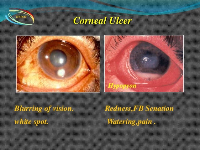 Blurry vision blurred vision cloudy vision causes treatments