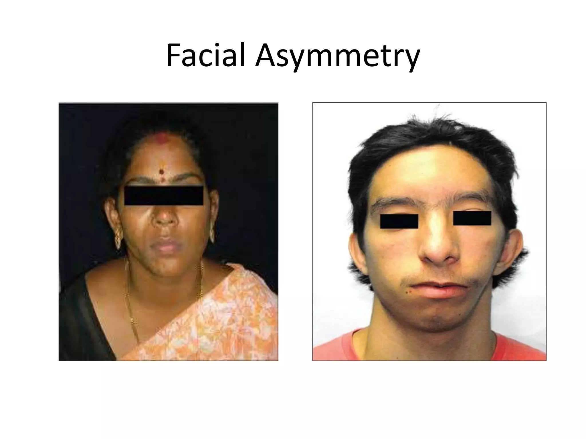 Facial Asymmetry
 
