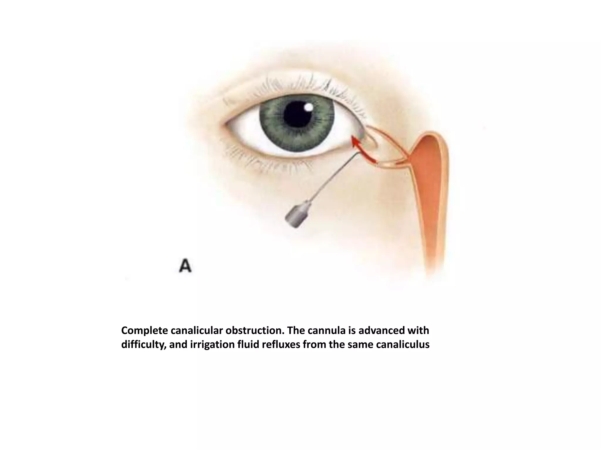 Complete canalicular obstruction. The cannula is advanced with
difficulty, and irrigation fluid refluxes from the same canaliculus
 