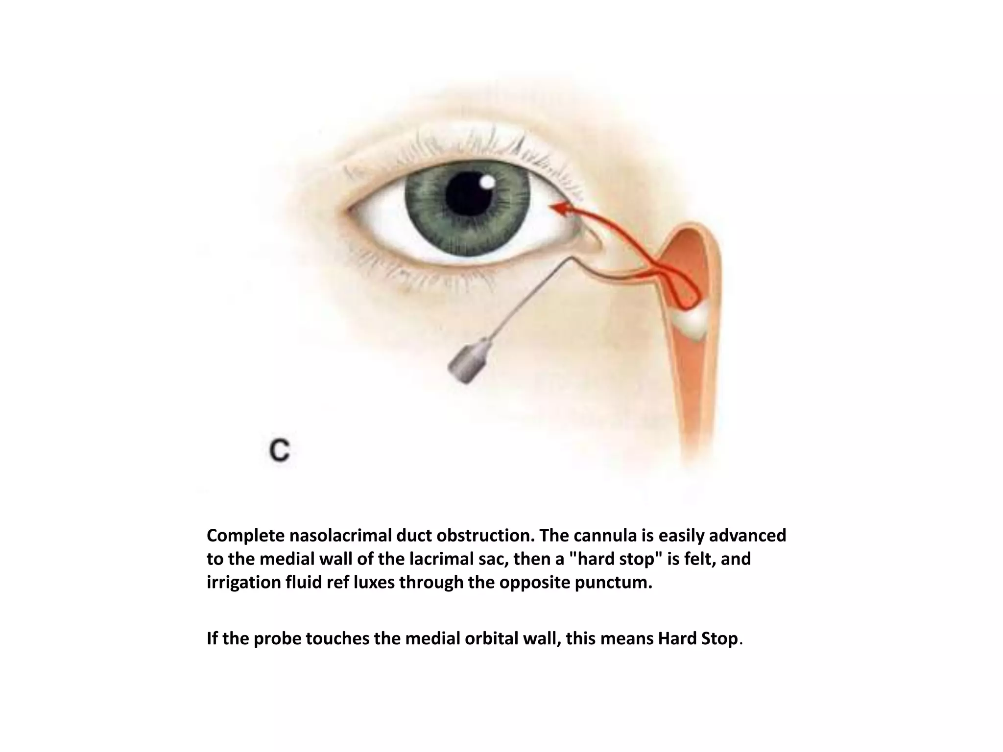 Complete nasolacrimal duct obstruction. The cannula is easily advanced
to the medial wall of the lacrimal sac, then a "hard stop" is felt, and
irrigation fluid ref luxes through the opposite punctum.
If the probe touches the medial orbital wall, this means Hard Stop.
 
