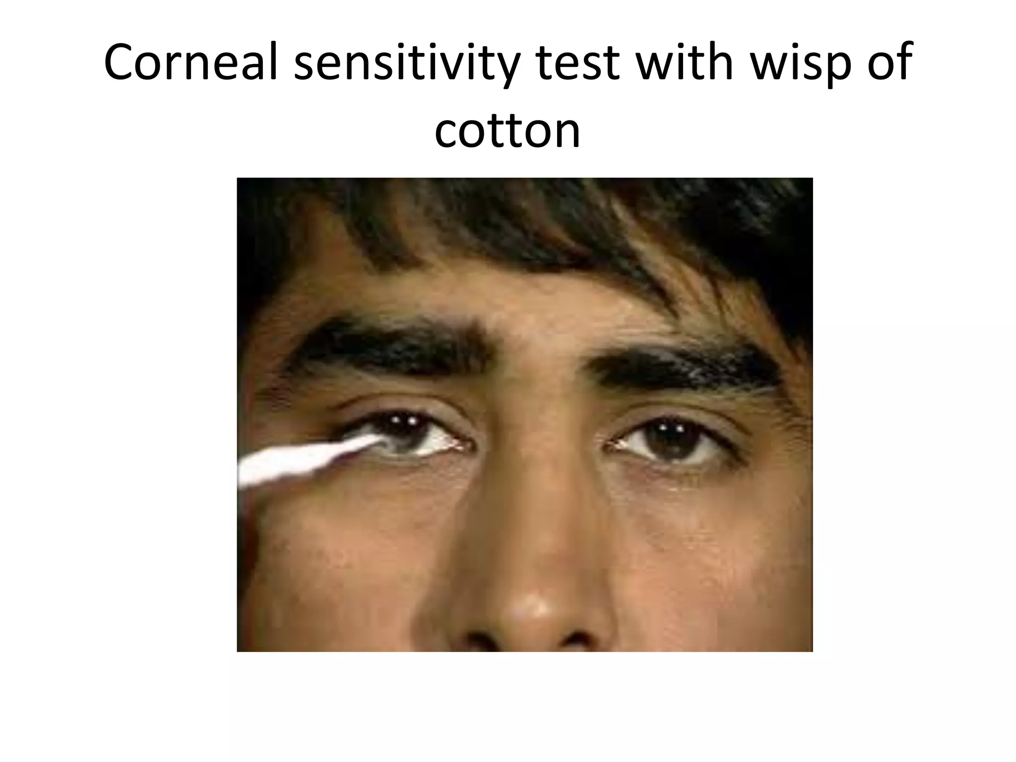Corneal sensitivity test with wisp of
cotton
 
