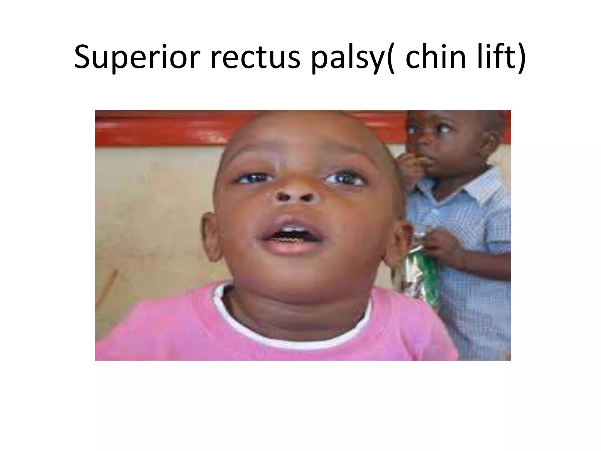 Superior rectus palsy( chin lift)
 