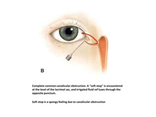 Complete common canalicular obstruction. A "soft stop" is encountered
at the level of the lacrimal sac, and irrigated fluid ref luxes through the
opposite punctum.
Soft stop is a spongy feeling due to canalicular obstruction
 