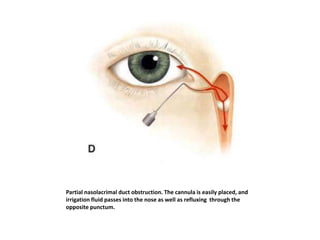 Partial nasolacrimal duct obstruction. The cannula is easily placed, and
irrigation fluid passes into the nose as well as refluxing through the
opposite punctum.
 
