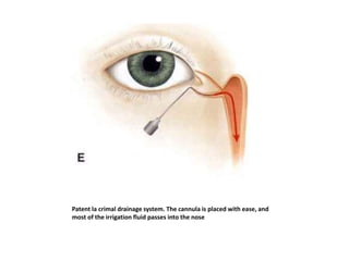 Patent la crimal drainage system. The cannula is placed with ease, and
most of the irrigation fluid passes into the nose
 