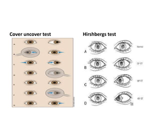 Cover uncover test Hirshbergs test
 
