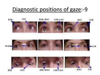 Diagnostic positions of gaze:-9
 