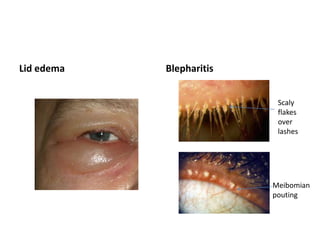 Lid edema Blepharitis
Meibomian
pouting
Scaly
flakes
over
lashes
 