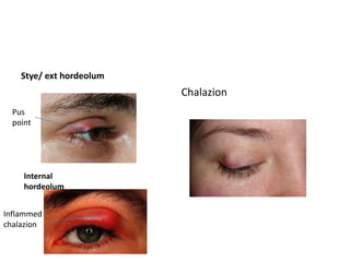 Stye/ ext hordeolum
Chalazion
Internal
hordeolum
Pus
point
Inflammed
chalazion
 