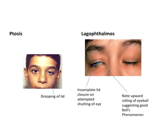 Ptosis Lagophthalmos
Drooping of lid
Incomplete lid
closure on
attempted
shutting of eye
Note upward
rolling of eyeball
suggesting good
Bell’s
Phenomenon
 