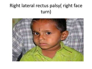 Right lateral rectus palsy( right face
turn)
 