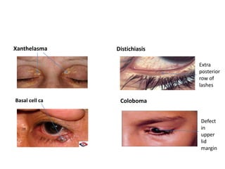 Xanthelasma Distichiasis
Basal cell ca Coloboma
Extra
posterior
row of
lashes
Defect
in
upper
lid
margin
 