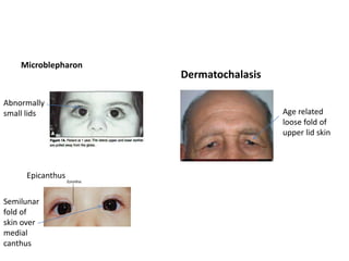 Microblepharon
Dermatochalasis
Epicanthus
Abnormally
small lids
Semilunar
fold of
skin over
medial
canthus
Age related
loose fold of
upper lid skin
 