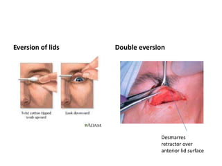 Eversion of lids Double eversion
Desmarres
retractor over
anterior lid surface
 