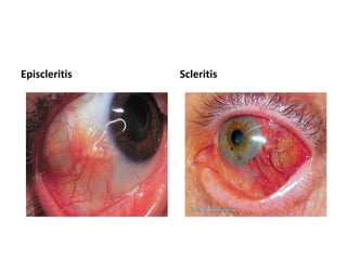 Episcleritis Scleritis
 