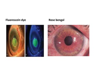 Fluorescein dye Rose bengal
 