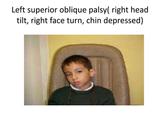 Left superior oblique palsy( right head
tilt, right face turn, chin depressed)
 