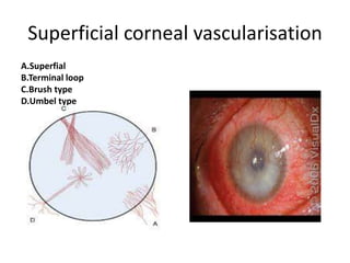 Superficial corneal vascularisation
A.Superfial
B.Terminal loop
C.Brush type
D.Umbel type
 