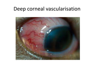 Deep corneal vascularisation
 