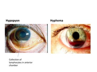 Hypopyon Hyphema
Collection of
lymphocytes in anterior
chamber
 