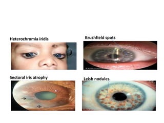 Heterochromia iridis Brushfield spots
Sectoral iris atrophy Leish nodules
 