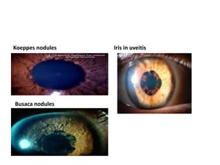 Koeppes nodules Iris in uveitis
Busaca nodules
 