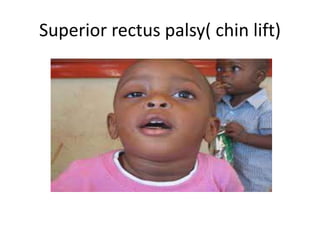 Superior rectus palsy( chin lift)
 
