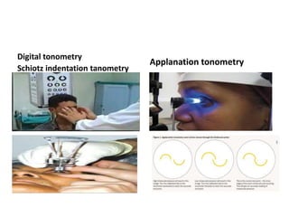 Digital tonometry
Schiotz indentation tanometry
Applanation tonometry
 