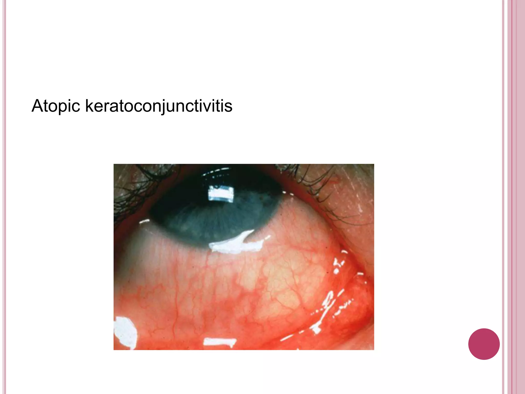 Atopic keratoconjunctivitis
 