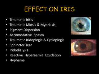 Ocular injuries | PPTX