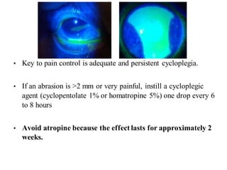 • Key to pain control is adequate and persistent cycloplegia.
• If an abrasion is >2 mm or very painful, instill a cycloplegic
agent (cyclopentolate 1% or homatropine 5%) one drop every 6
to 8 hours
• Avoid atropine because the effect lasts for approximately 2
weeks.
 