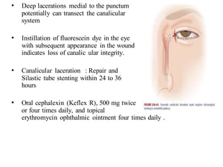 • Deep lacerations medial to the punctum
potentially can transect the canalicular
system
• Instillation of fluorescein dye in the eye
with subsequent appearance in the wound
indicates loss of canalic ular integrity.
• Canalicular laceration : Repair and
Silastic tube stenting within 24 to 36
hours
• Oral cephalexin (Keflex R), 500 mg twice
or four times daily, and topical
erythromycin ophthalmic ointment four times daily .
 