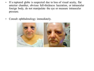 • If a ruptured globe is suspected due to loss of visual acuity, flat
anterior chamber, obvious full-thickness laceration, or intraocular
foreign body, do not manipulate the eye or measure intraocular
pressure.
• Consult ophthalmology immediately.
 