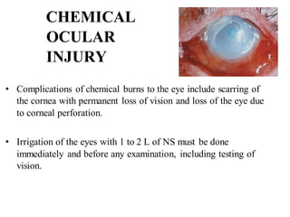 CHEMICAL
OCULAR
INJURY
• Complications of chemical burns to the eye include scarring of
the cornea with permanent loss of vision and loss of the eye due
to corneal perforation.
• Irrigation of the eyes with 1 to 2 L of NS must be done
immediately and before any examination, including testing of
vision.
 