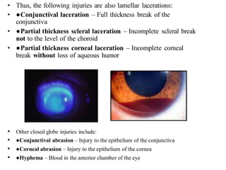 • Thus, the following injuries are also lamellar lacerations:
• ●Conjunctival laceration – Full thickness break of the
conjunctiva
• ●Partial thickness scleral laceration – Incomplete scleral break
not to the level of the choroid
• ●Partial thickness corneal laceration – Incomplete corneal
break without loss of aqueous humor
• Other closed globe injuries include:
• ●Conjunctival abrasion – Injury to the epithelium of the conjunctiva
• ●Corneal abrasion – Injury to the epithelium of the cornea
• ●Hyphema – Blood in the anterior chamber of the eye
 