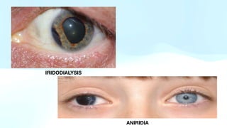 OCULAR INJURIES | PDF