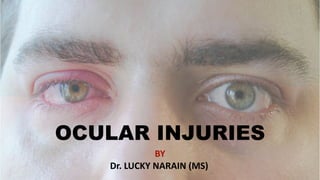 OCULAR INJURIES
BY
Dr. LUCKY NARAIN (MS)
 