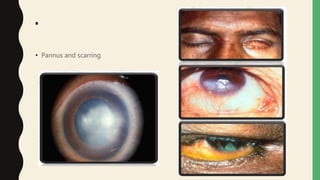 .
• Pannus and scarring
 