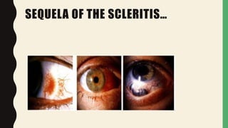 SEQUELA OF THE SCLERITIS…
 