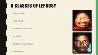 6 CLASSES OF LEPROSY
• Indeterminate
• Tuberculoid
• Borderline tuberculoid
• Borderline
• Borderline lepromatous
• Lepromatous
 